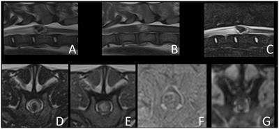 Case report: Surgical treatment and long-term successful outcome of a spinal intramedullary vascular malformation in a dog